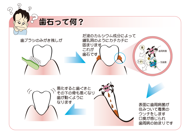歯石